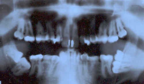 dentures x-ray